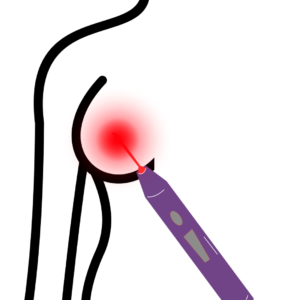 Grafische Darstellung einer Brust, die zur Wundheilung mit einem Softlaser (Low-Level-Laser) behandelt wird, erkennbar an dem roten Lichtpunkt.
