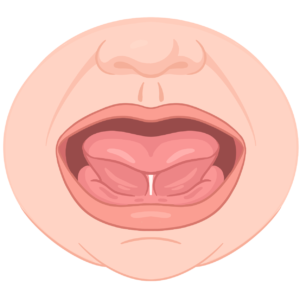 Illustration eines geöffneten Babymundes, bei dem ein zu kurzes Zungenbändchen unter der Zunge deutlich sichtbar ist.